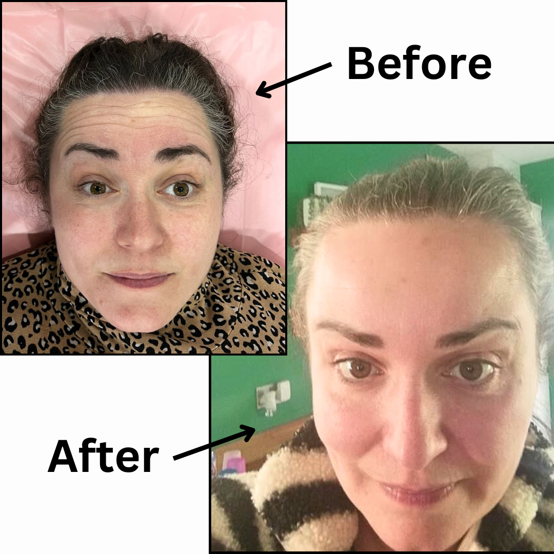 botox anti wrinkle injections before and after client photos