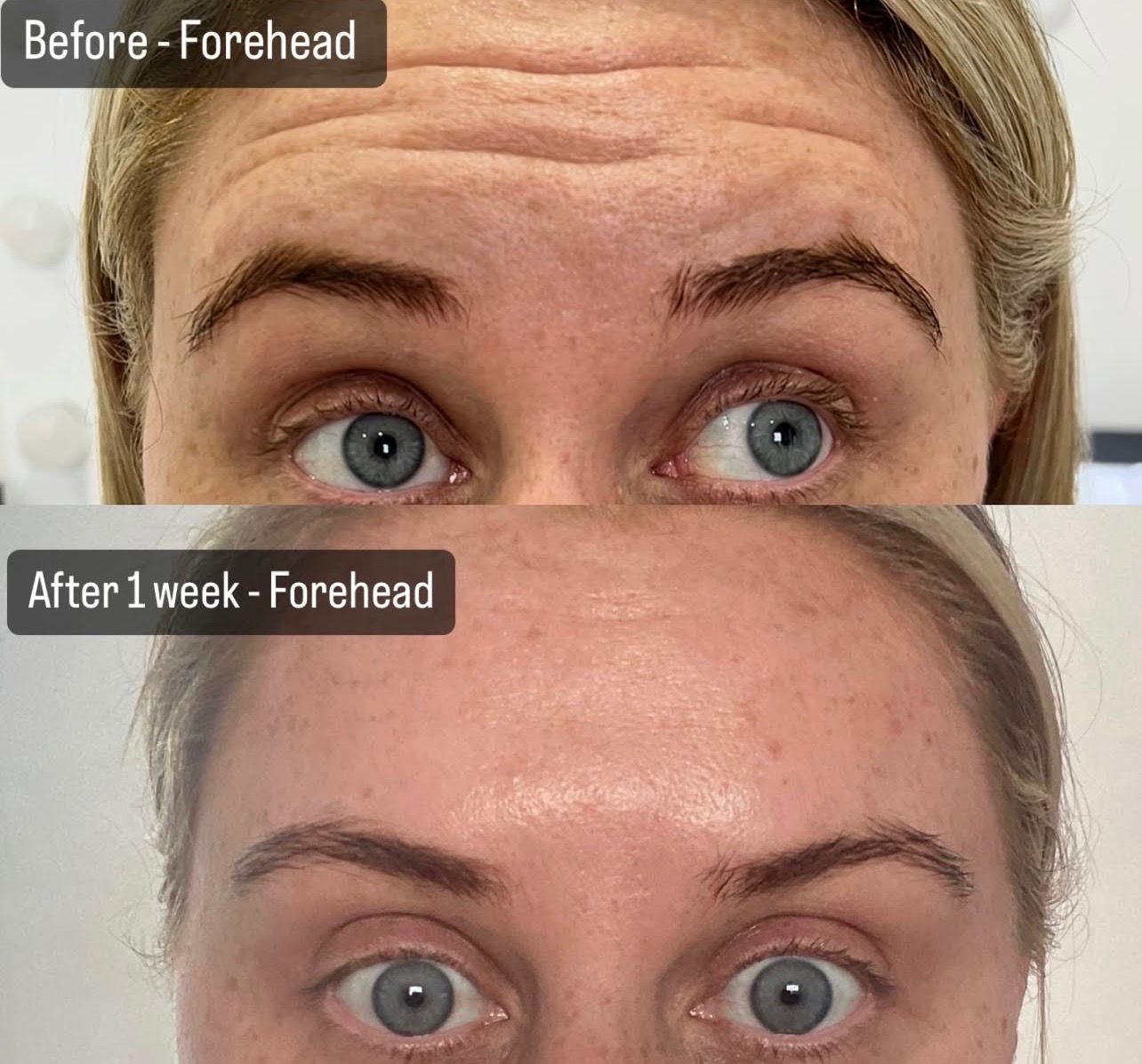 anti wrinkle near me injections botox solution