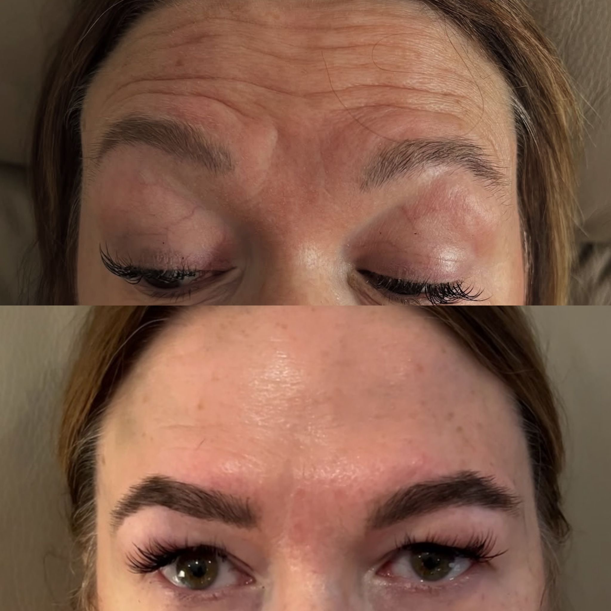 anti wrinkle near me injections botox solution
